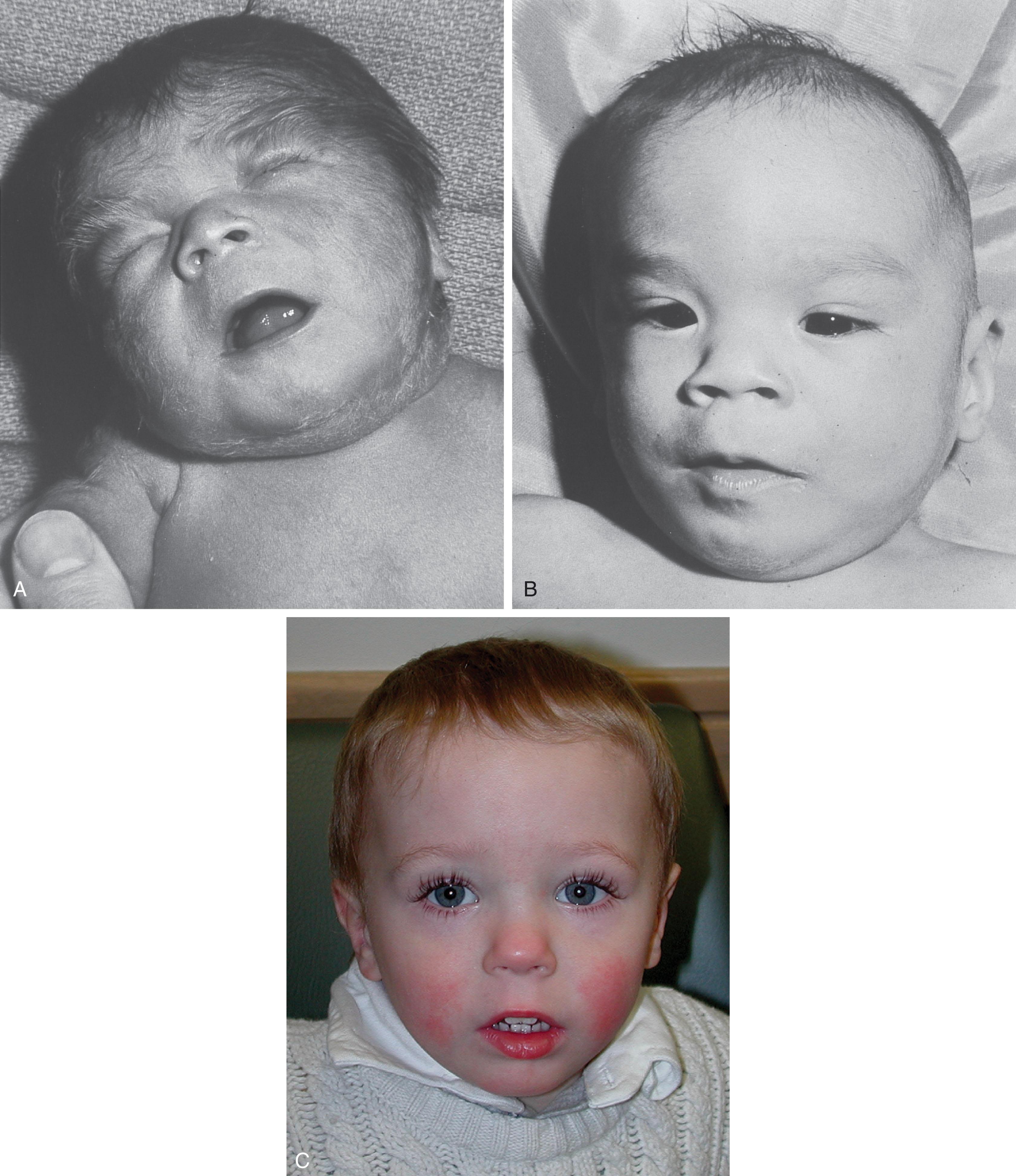 Fig. 42.3, Fetal alcohol syndrome: clinical appearance.