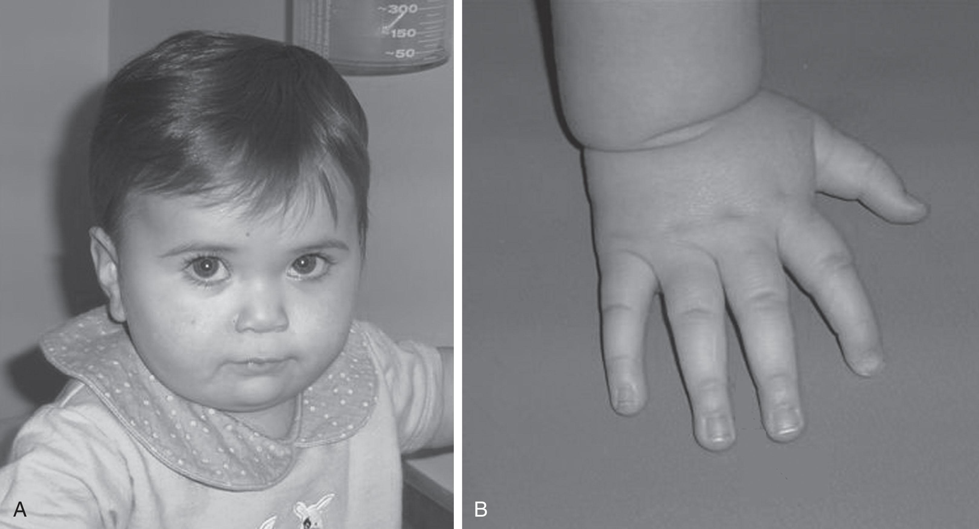 Fig. 42.6, Fetal valproate syndrome, clinical appearance.