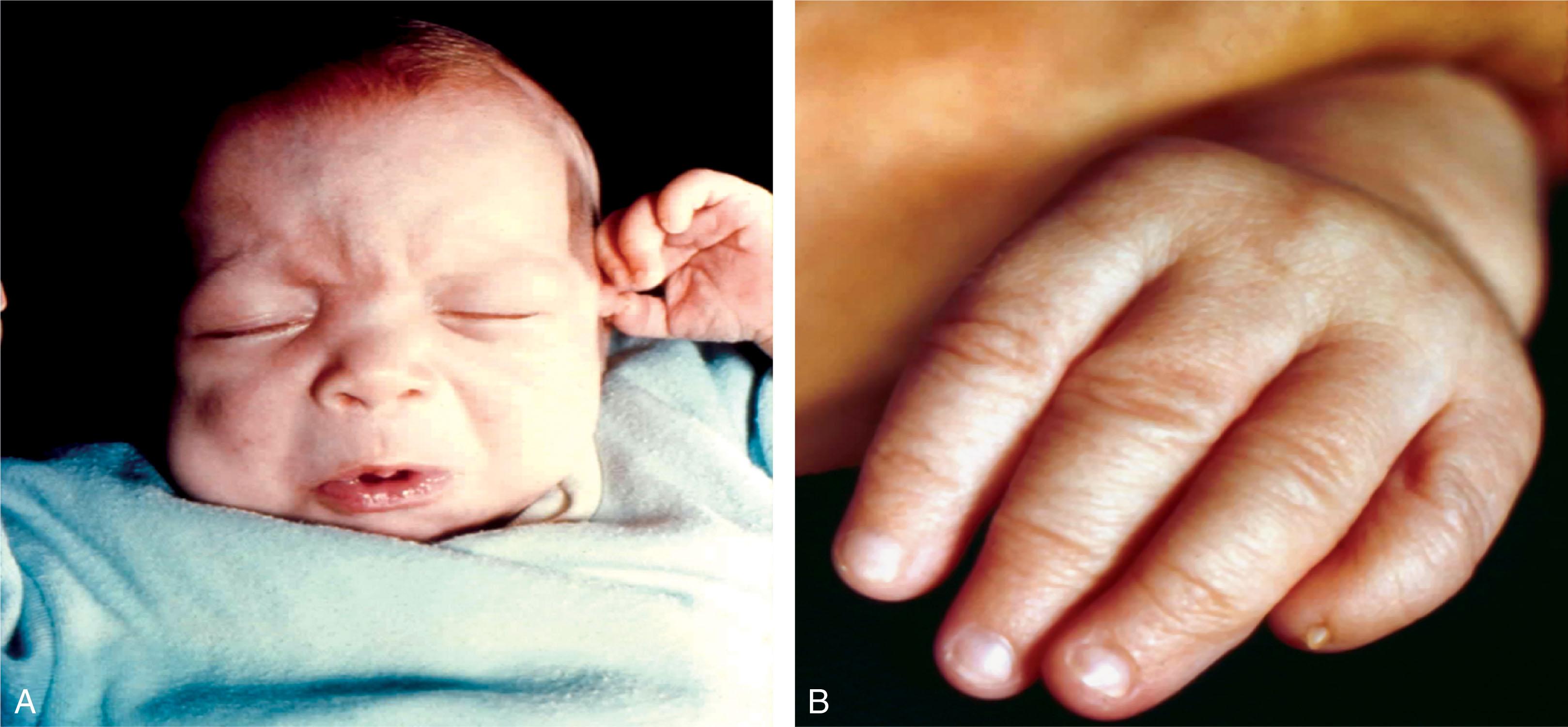 Fig. 42.7, Fetal hydantoin syndrome.