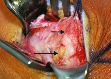 Fig. 60.3, The medial patellofemoral ligament is found between the second and third layers of the medial extensor structures (small arrow). A chronic tear with avulsion of the ligament from the medial femoral condyle is displayed (large arrow).