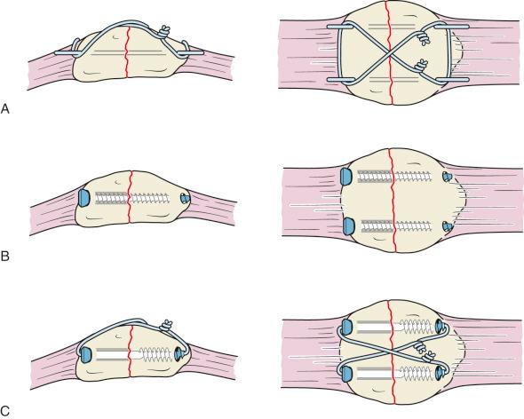 Fig. 60.6, Comparison of constructs for internal fixation of patella fractures. (A) Modified Arbeitsgemeinschaft für Osteosynthesefragen (AO) 12 tension-band construct. (B) AO compression screws, 4.5 mm. (C) Cannulated 4.0-mm screws combined with a tension band.