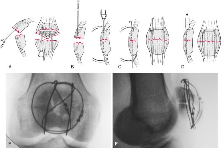 Fig. 60.7, Modified Arbeitsgemeinschaft für Osteosynthesefragen (AO) 12 tension-band technique for patella fracture fixation. (A) Retrograde drilling of the proximal fragment. Kirschner wires (K-wires) mark the proximal ends of the holes during reduction. (B) Reduction, clamping, and antegrade partial drilling of the distal fragment. K-wires with prebent proximal ends are then hammered through the remaining bone of the distal pole. (C) With a large-bore needle, the 1.2-mm tension-band wire is placed deep to the proximal and distal ends of the K-wires immediately adjacent to the patella through the stout soft tissue attachments of the quadriceps tendon and patellar ligament. Medially and laterally, the tension-band wire lies anterior to the patella and is not usually crossed. It is tightened and twisted securely, and the “pigtail” end is bent flush with the bone surface. A twist or a square knot is reliable. The AO bent-wire fastening technique is not secure enough for definitive fixation. (D) The prebent proximal ends of the K-wires are driven into the proximal pole, and the distal ends are trimmed if necessary. (E and F) Anterior-posterior (AP) and lateral radiographs show a displaced comminuted patellar fracture stabilized with a modified AO tension-band technique supplemented with a cerclage wire.