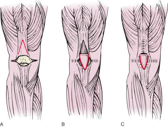 Fig. 60.9, Inverted V-plasty of Shorbe and Dobson for repair of a patellectomy defect. (A) The patella is resected, with a transverse defect left in the quadriceps mechanism. The retinacular rents are repaired first. (B) If a defect remains centrally, an inverted, distally based, V-shaped flap of quadriceps tendon is turned distally as shown. (C) The flap is sutured in place to cover and reinforce the defect.