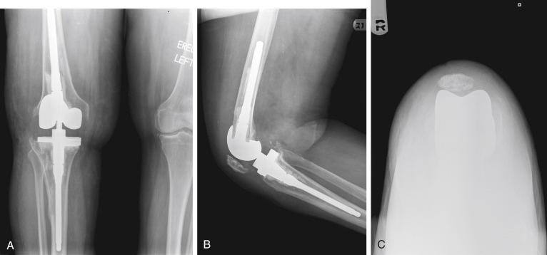 FIGURE 24.4, A to C, Postoperative radiographs show a well-aligned revision total knee arthroplasty with the patella tracking centrally in the trochlear groove.