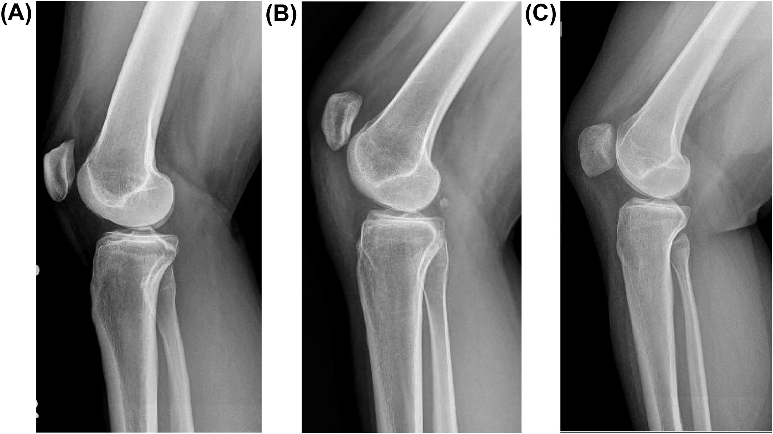 Fig. 8.1, Trochlear dysplasia. (A) Mild dysplasia: the trochlear groove line reaches the anterior femur before the anterior femoral cortical line intersects with it (“crossing sign”). (B) Moderate dysplasia: crossing sign plus small prominence of the supratrochlear bone. (C) Severe dysplasia: crossing, large supratrochlear prominence and evidence of a hypoplastic medial trochlear facet (“double contour”).