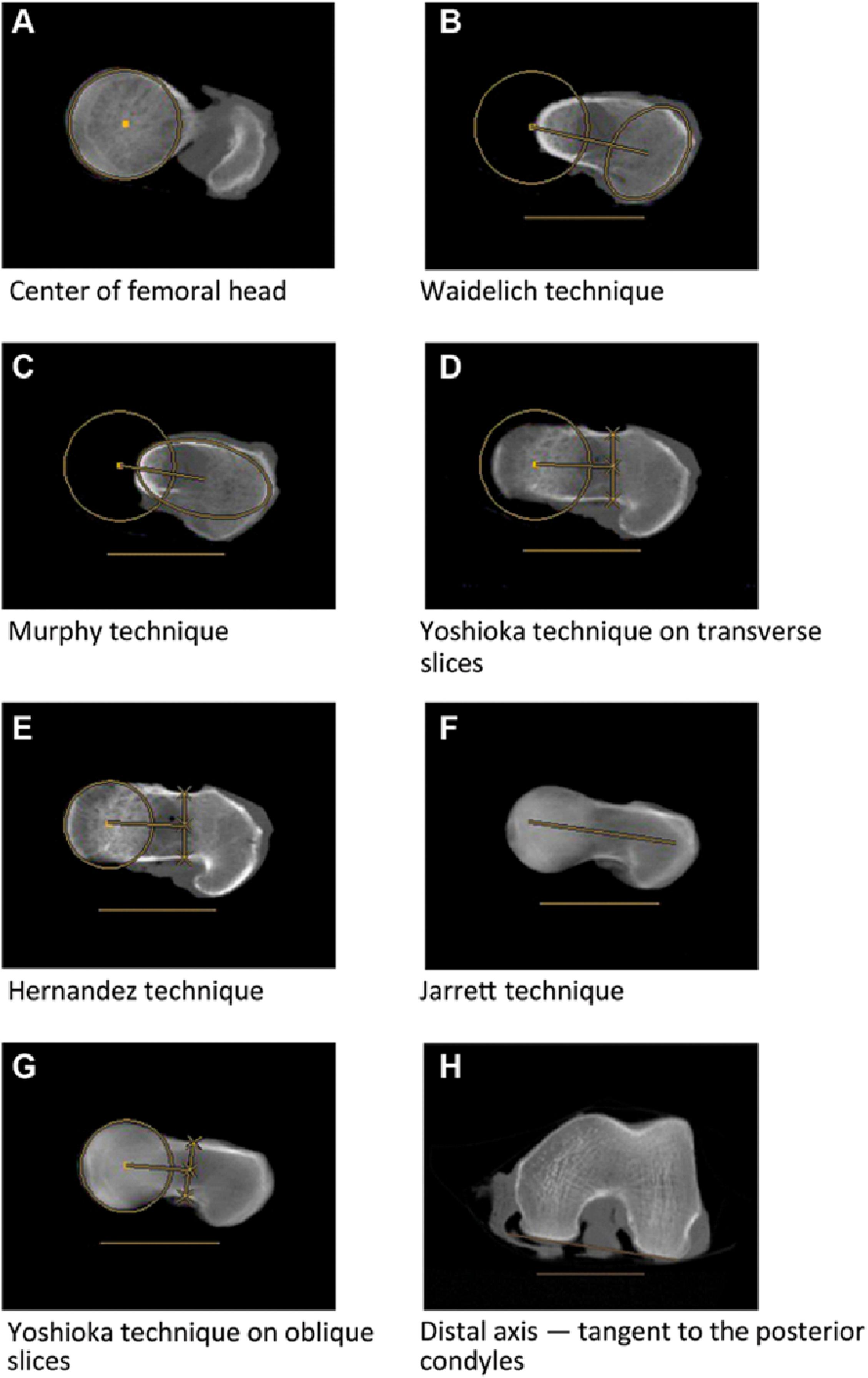 Fig. 8.4, Femoral anteversion. The various methods of measurement of the femoral neck for use in quantification of femoral anteversion.