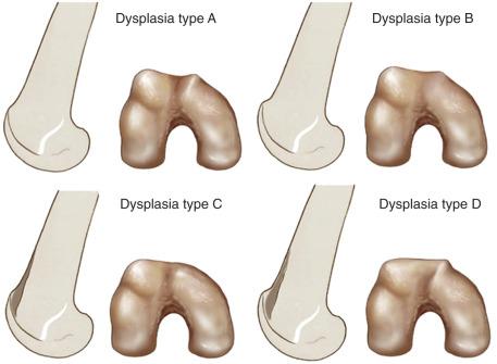 Patellar Instability - Clinical Tree
