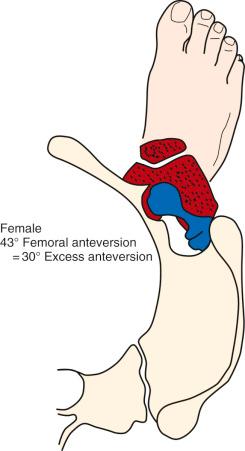 FIG 36-11, Female with 30 degrees of increase in femoral anteversion. The knee joint points in the same direction, slightly inward, as in the normal female, but the greater trochanter points posteriorly, giving a poor mechanical advantage. At some point, the hip cannot externally rotate enough to keep the knee joint pointed forward. With fatigue of the hip abductors, the knee points more inward to compensate for hip collapse, placing greater stress on the knee.
