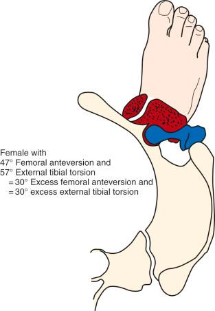 FIG 36-12, Female with a 30 degrees of increase in both femoral anteversion and external tibial torsion. Note the trochanter is pointed more anterior than normal, and with the foot progression angle normal, the knee joint axis points markedly inward.