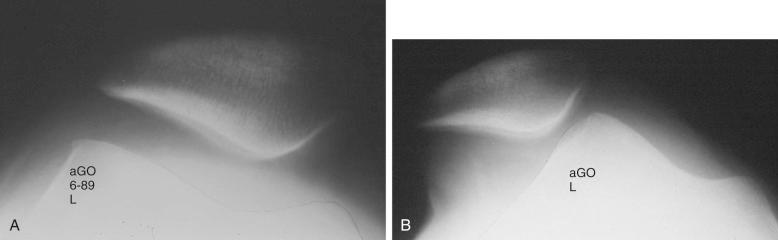 FIG 36-2, A, An 18-year-old patient complained of anterior knee pain and giving way, without a history of dislocation. Radiographic parameters are normal. B, Stress application was necessary to demonstrate dislocation.