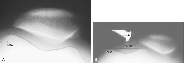 FIG 36-3, A, Radiograph of a 38-year-old woman with anterior knee pain after a dashboard injury. Symptoms worsened after a lateral retinacular release. Radiographic parameters were normal. B, Stress radiographs demonstrated medial dislocation.