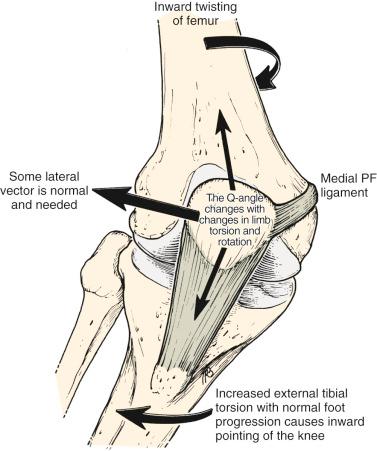 FIG 36-4, If the knee joint twists inward because the femur twists inward, the lateral pull on the quadriceps is increased, the lateral displacement pull on the patella is increased, the strain on the medial patellofemoral (PF) ligament is increased, the compression on the lateral patellar facet is increased, and the compression on the medial patellar facet is decreased. The treatment must be to decrease the inward twist on the knee joint, not to move the tubercle medially. A similar increase of inward pointing of the knee joint occurs in the presence of excess external tibial torsion when the foot is pointed forward.