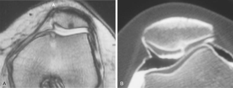 FIG 36-5, A, Magnetic resonance imaging read as focal osteonecrosis. B, Contrast computed tomography arthrogram clearly shows a split in the articular cartilage extending down to the cystic lesion with damaged articular cartilage medial to the cartilage split. Most likely, there was an acute subluxation episode that compressed the articular cartilage until it failed with a split relieving ligament tension, with further lateral subluxation damaging the medial articular cartilage into which the contrast dye now moves. A, Anterior.