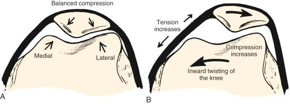 FIG 36-6, A, If the knee joint moves forward, the compression on the patellofemoral joint and ligaments tensioned are balanced. B, If the knee joint twists inward from beneath the patella, the medial patellofemoral ligament is placed under increased tension, the compression beneath the lateral facet increases, and the compression beneath the medial facet decreases.