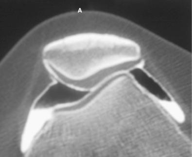 FIG 36-7, As the femur rotates internally beneath the patella, the lateral patellar articular cartilage is compressed. The increased crescentric density in the lateral patellar subchondral bone is indicative of chronic localized pressure. A, Anterior.