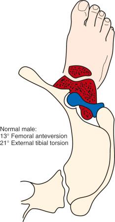 FIG 36-8, Normal male with femoral anteversion of 13 degrees and external tibial torsion of 21 degrees. Note that with a foot progression angle of 13 degrees, the knee joint faces slightly outward.