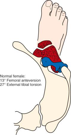 FIG 36-9, Normal female with femoral anteversion of 13 degrees and external tibial torsion of 27 degrees. Note that the knee joint is pointing slightly more inward and the greater trochanter is slightly more anterior than the normal male.