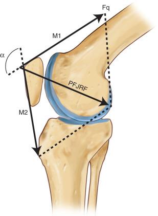 Fig. 106.1, The patellofemoral joint reaction force (PFJRF) becomes higher as the knee flexion angle increases. In complete extension, M1 and M2 are in opposite directions, but in the same plane; the resultant PFJRF is almost zero. As flexion increases, M1 and M2 converge, and the vector PFJRF increases.