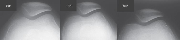 Fig. 106.11, Axial views performed at 30, 60, and 90 degrees of knee flexion. Note how the trochlear shape changes as flexion increases and the medial facet seems bigger. It is not necessary to routinely perform 60- and 90-degree flexion radiographs in common patellofemoral disorders.