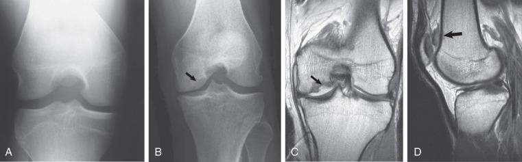 Fig. 106.12, Tunnel view. (A) A normal tunnel view demonstrates the posterior aspect of the femoral condyles, the tibial spines, the articular surfaces of the tibial plateau, and the intercondylar notch. (B) A tunnel view from a different patient demonstrating an ovoid area of lucency at the inner margin of the medial femoral condyle (arrow) that is suspicious for osteochondritis dissecans. Coronal (C) and sagittal proton density (D) magnetic resonance imaging confirms the large osteochondral defect (arrow) with a completely displaced osteochondral fragment located in the suprapatellar joint recess (arrow).
