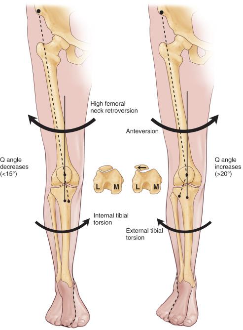 Fig. 106.4, High femoral neck retroversion rotates the distal end of the femur externally. In combination with internal tibial torsion, the Q angle is decreased. Patellar tracking is improved, and patellofemoral sulcus alignment is normal. High femoral neck anteversion rotates the distal end of the femur internally. In combination with external tibial torsion, the Q angle is increased. Patellar tracking is compromised, and the patella tends to track laterally.