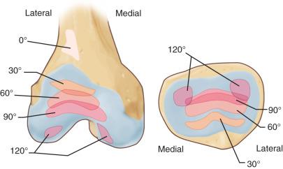 Fig. 106.7, The patellofemoral joint contact areas according to the knee flexion angle.