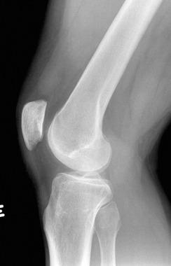 Fig. 106.9, Lateral radiograph of the knee.