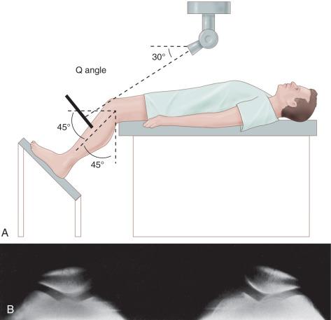 Fig. 106.10, Merchant view. (A) Technique. (B) A normal Merchant view. Patellofemoral alignment is normal bilaterally, and the osseous structures and articular cortices are normal.