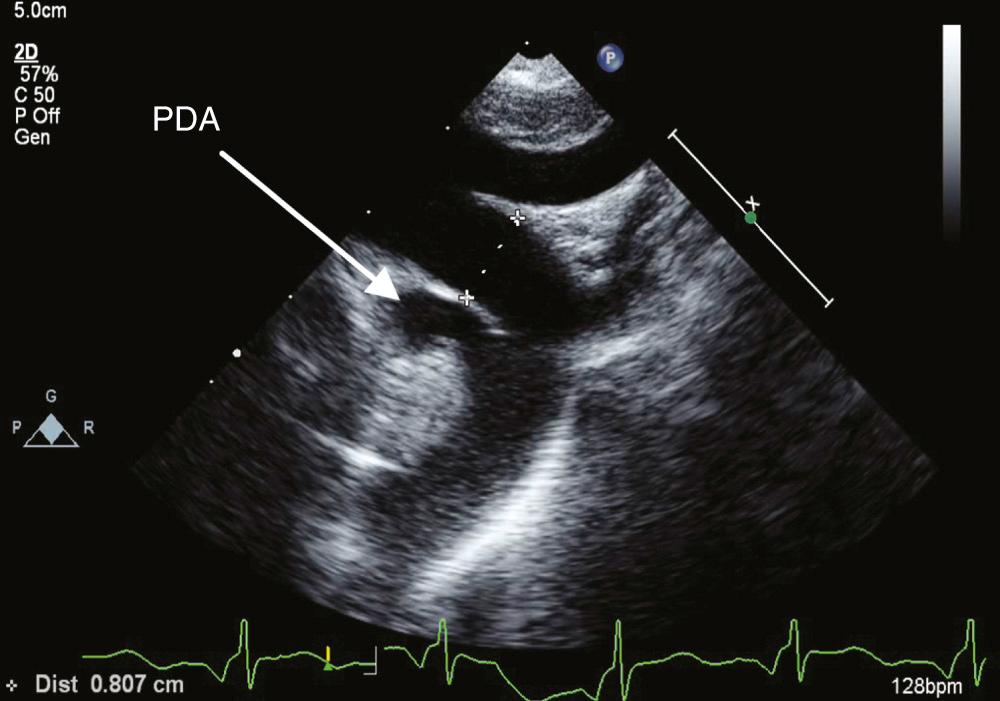 FIGURE 113-1, Echocardiographic appearance of the patent ductus arteriosus (PDA). Note the insertion just distal to the takeoff of the left subclavian artery.