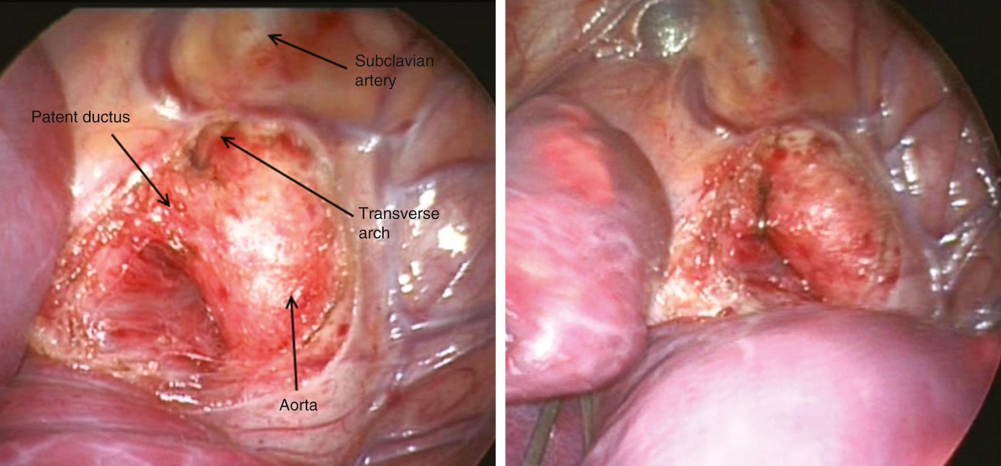 FIGURE 113-2, Intraoperative view of patent ductus arteriosus before (left) and after (right) clip placement.