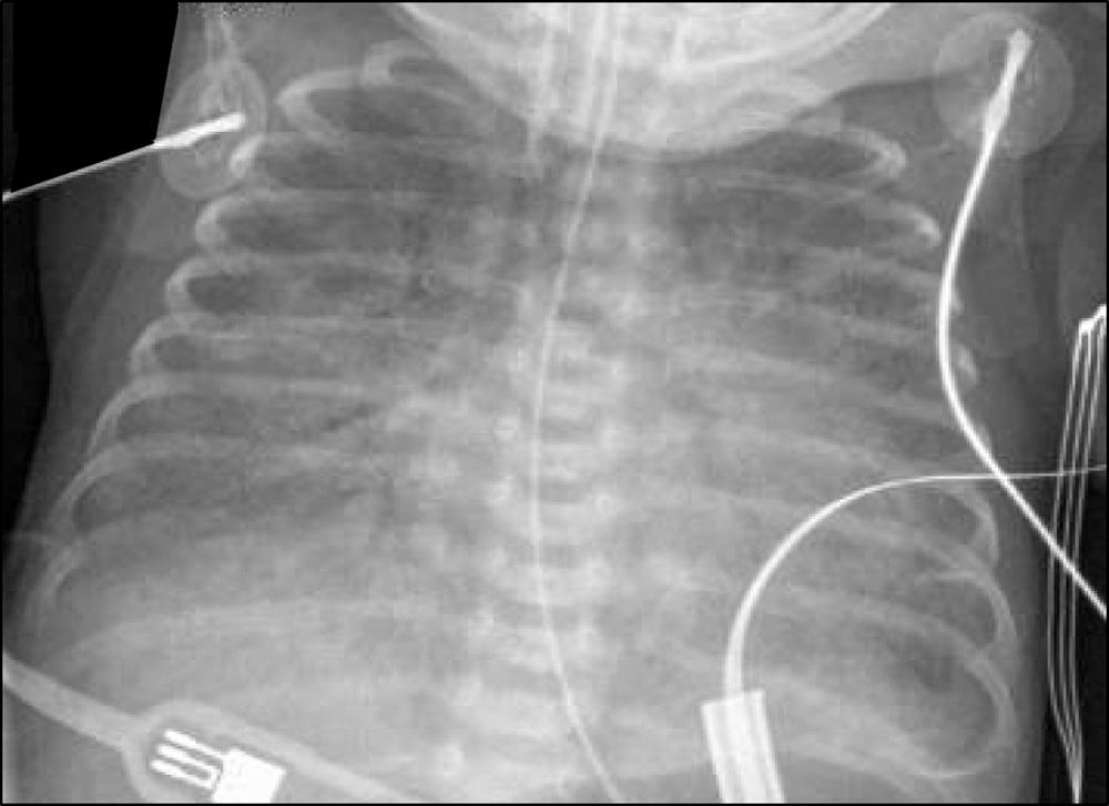 Fig. 14.3, CXR demonstrating pulmonary edema and enlarged cardiac silhouette consistent with hemodynamically significant left-to-right shunting at the ductus.