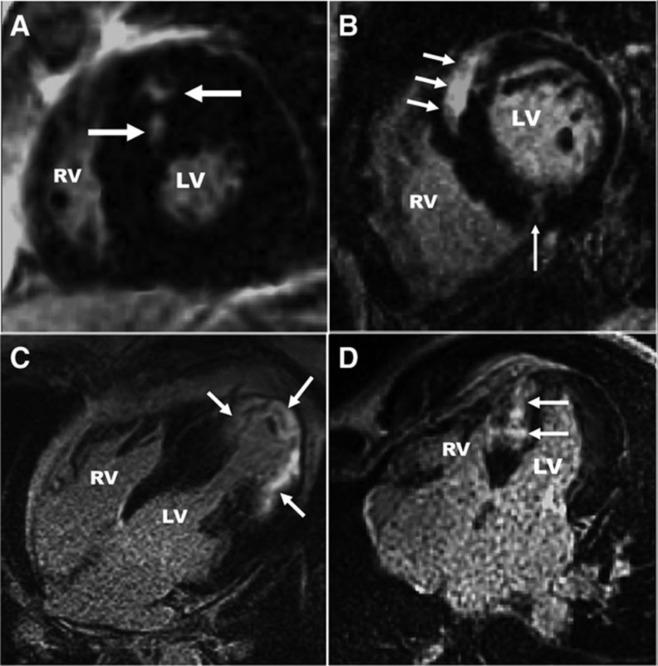 Fig. 9.4, Heterogeneity of Cardiac Fibrosis in Hypertrophic Cardiomyopathy.