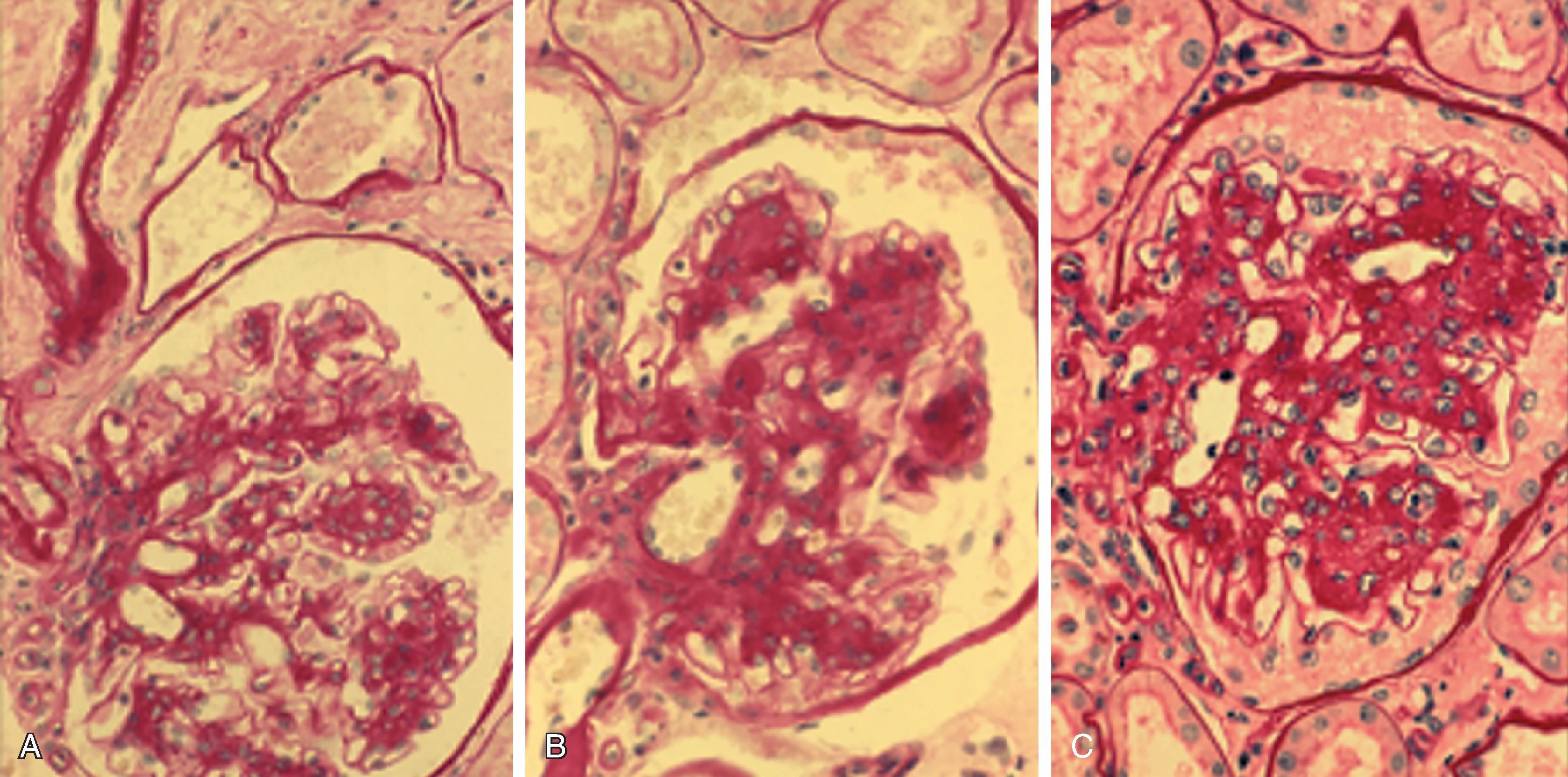 Fig. 26.1, Light microscopy photographs of glomeruli in sequential kidney biopsies performed at baseline and after 5 and 10 years of follow-up in a patient with long-standing normoalbuminuric type 1 diabetes with progressive mesangial expansion and kidney function deterioration. (A) Diffuse and nodular mesangial expansion and arteriolar hyalinosis in this glomerulus from a patient who was normotensive and normoalbuminuric at the time of this baseline biopsy, 21 years after diabetes onset (periodic acid–Schiff [PAS] stain, original magnification ×400). (B) Five-year follow-up biopsy showing worsening of the diffuse and nodular mesangial expansion and arteriolar hyalinosis in this now microalbuminuric patient with declining glomerular filtration rate (GFR) (PAS stain, ×400). (C) Ten-year follow-up biopsy showing more advanced diabetic glomerulopathy in this now proteinuric patient with further reduced GFR. Note also the multiple small glomerular (probably efferent) arterioles in the hilar region of this glomerulus (PAS stain, ×400) and in the glomerulus shown in (A).