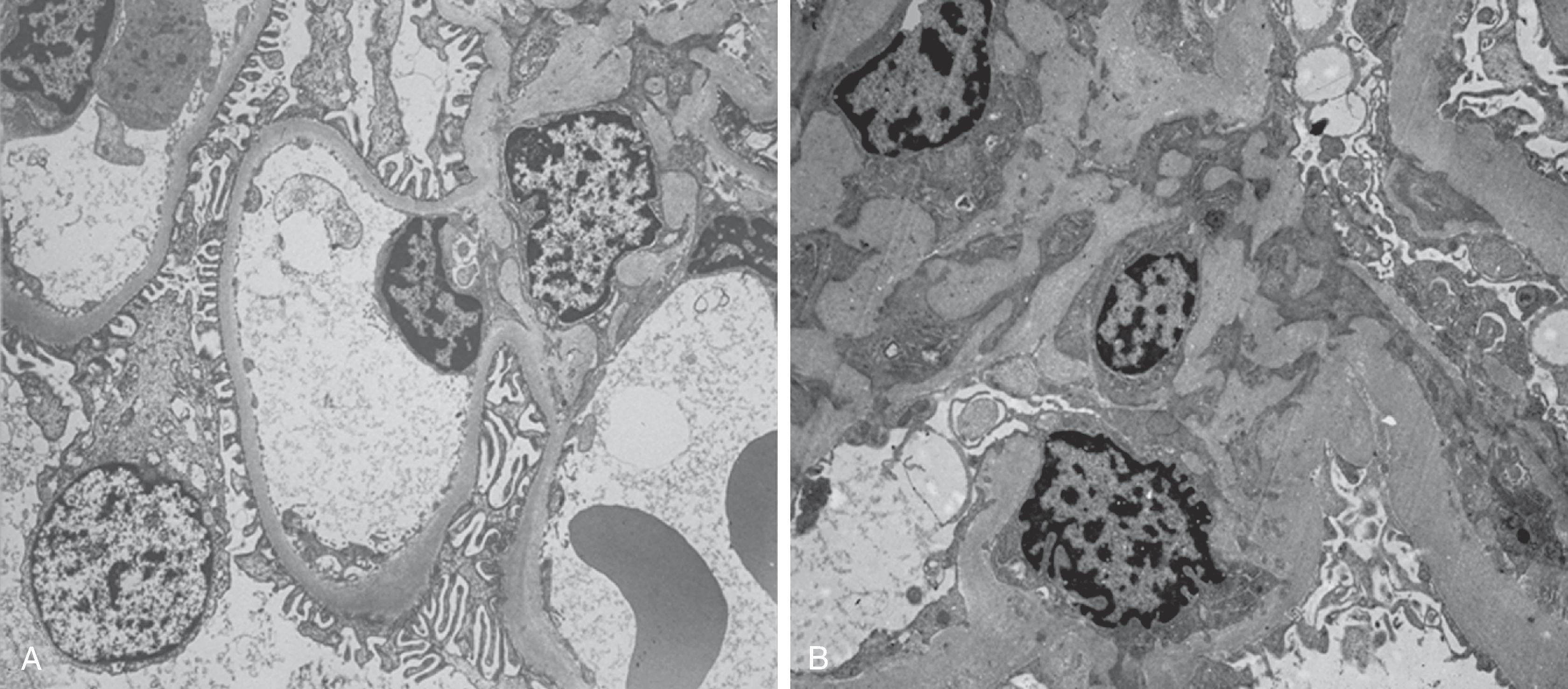 Fig. 26.2, Electron microscopy photographs of mesangial area in a normal control individual (A) and in an individual with type 1 diabetes (B) (original magnification ×3900). Note the increase in mesangial matrix and cell content, the glomerular basement membrane thickening, and the decrease in the capillary luminal space in the diabetic patient (B).