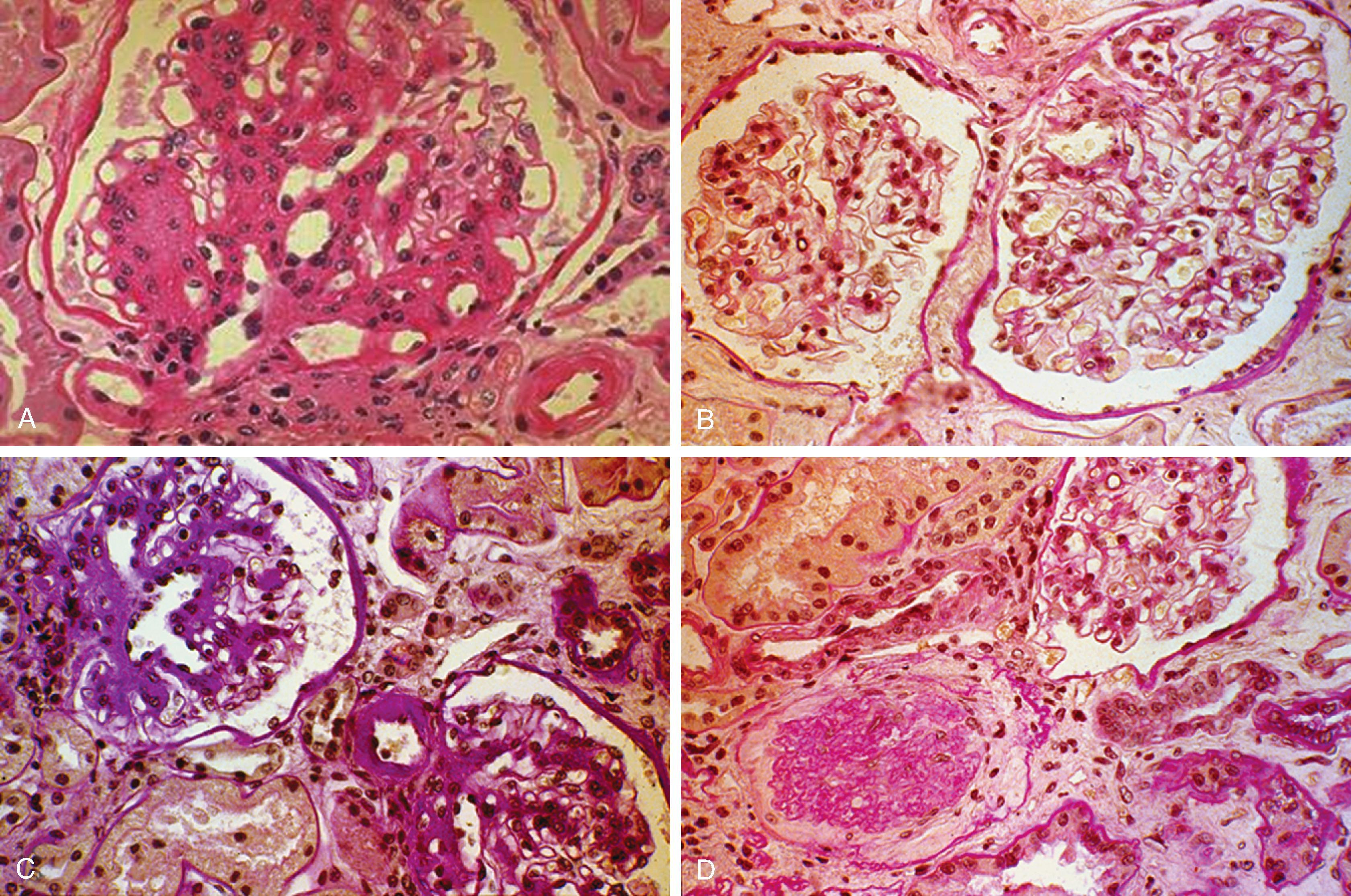 Fig. 26.3, Light microscopy photographs of glomeruli from type 1 (A) and type 2 (B through D) diabetic patients. (A) Diffuse and nodular mesangial expansion and arteriolar hyalinosis in a glomerulus from an individual with type 1 diabetes and moderately elevated albuminuria (periodic acid–Schiff [PAS] stain, original magnification ×400). (B) Normal or near-normal kidney structure in a glomerulus from an individual with type 2 diabetes and moderately elevated albuminuria (PAS stain, ×400). (C) Changes “typical” of diabetic kidney disease (glomerular, tubulointerstitial, and arteriolar changes occurring in parallel) in a kidney biopsy specimen from an individual with type 2 diabetes and moderately elevated albuminuria (PAS stain, ×400). (D) “Atypical” patterns of injury, with absent or only mild diabetic glomerular changes associated with disproportionately severe tubulointerstitial changes. Note also a glomerulus undergoing glomerular sclerosis (PAS stain, ×400) (B through D).
