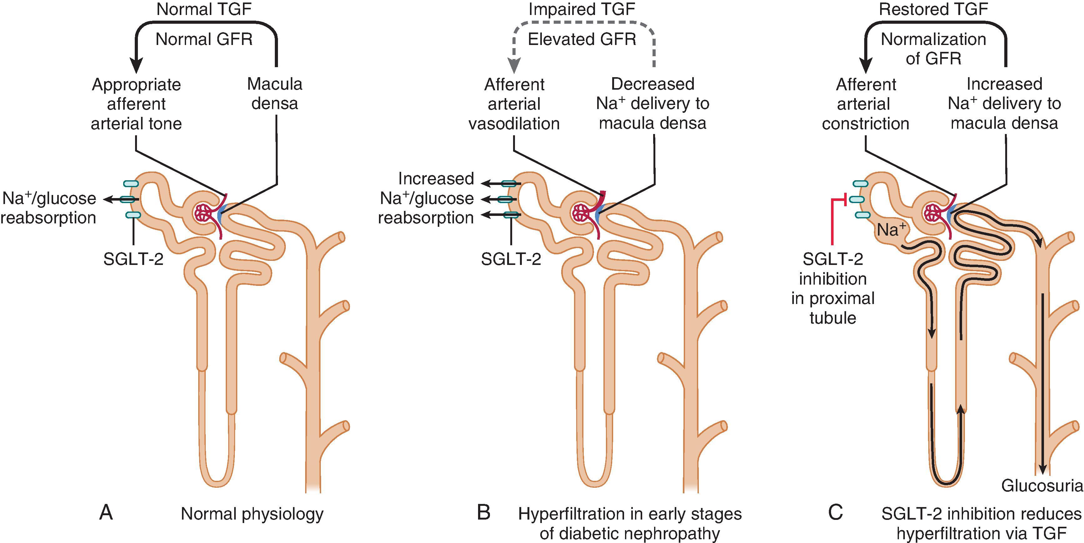 Fig. 26.5, Proposed tubuloglomerular feedback mechanisms in (A) normal physiology, (B) early stages of diabetic nephropathy, and (C) after sodium-glucose cotransporter 2 (SGLT-2) inhibition. GFR, Glomerular filtration rate; TGF , tubuloglomerular feedback; (Adapted from Cherney DZI, Perkins BA, Soleymanlou N, et al: The renal hemodynamic effect of sodium-glucose cotransporter 2 inhibition in patients with type 1 diabetes mellitus. Circulation 129(5):587–597, 2014.)