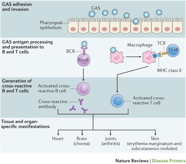 Fig. 2.1, Generation of a cross-reactive immune response in acute rheumatic fever (ARF). Following GAS adhesion to and invasion of the pharyngeal epithelium, GAS antigens activate both B and T cells. Molecular mimicry between GAS group A carbohydrate and serotype-specific M protein and the host heart, brain, or joint tissues can lead to an autoimmune response, which causes the major manifestations of ARF. BCR, B-cell receptor; TCR, T-cell receptor.