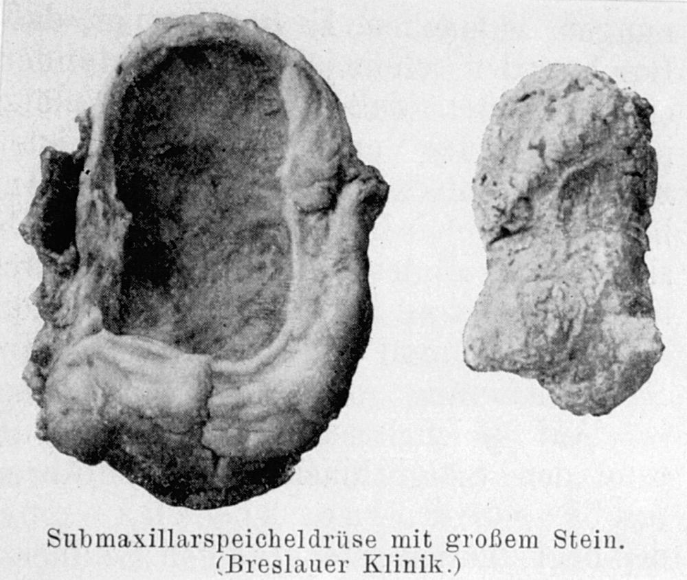 Fig. 10.2, Submandibular gland with a large sialolith. (Fig. 357 from Küttner, 1926 4 .)