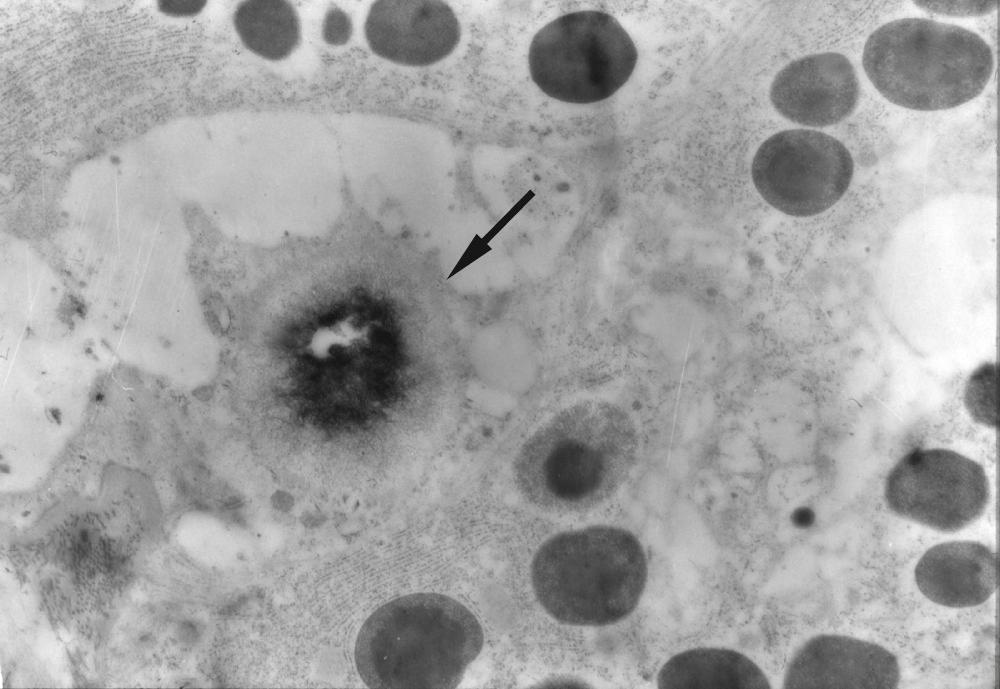 Fig. 10.3, Electronmicrograph shows a sialomicrolith in an autophagosome (arrow) in a serous acinar cell of submandibular gland. The sialomicrolith would not be identifiable except by electronmicroscopy because it is of a similar size to the secretory granules. Electronmicroscopical microanalysis identified crystals containing calcium and phosphorus in the sialomicrolith. (×12,600)