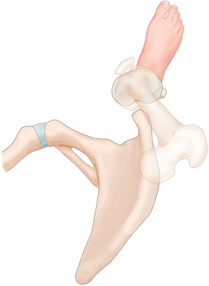 Fig. 29.1, A limb in the horizontal plane of a patient with ‘miserable malalignment’. When the femoral anteversion is increased by 30 degrees, the external tibial torsion is increased by 30 degrees and the foot is placed with a foot progression angle of 15 degrees, the knee joint is pointed markedly inward, placing the pull of the quadriceps at a greater diagonal pull.