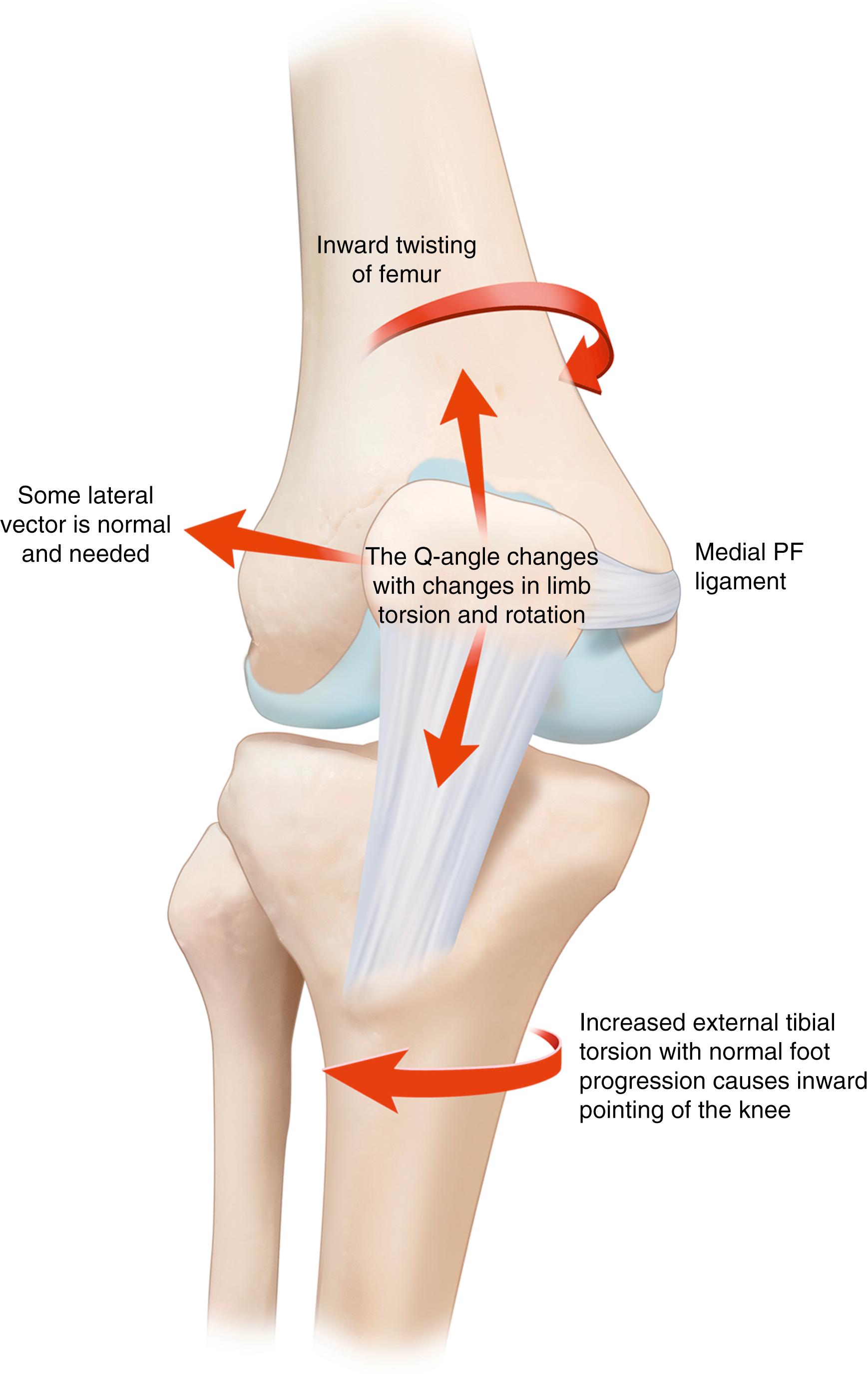 Fig. 29.3, Inward pointing of the knee is most commonly increased when there is increased internal torsion of the femur or when there is excessive external torsion of the tibia. When there is excess femoral anteversion and hip abductor muscle strength is needed, the trochanter is moved anteriorly and the knee joint is therefore pointed internally. When there is excess external tibial torsion and the foot is pointed forward, the knee joint is pointed inward. Because the pull on the quadriceps is lateral, pointing the knee joint more inward increases the magnitude of the lateral pull, increasing the pull on the medial structures and increasing the compression on the lateral structures.