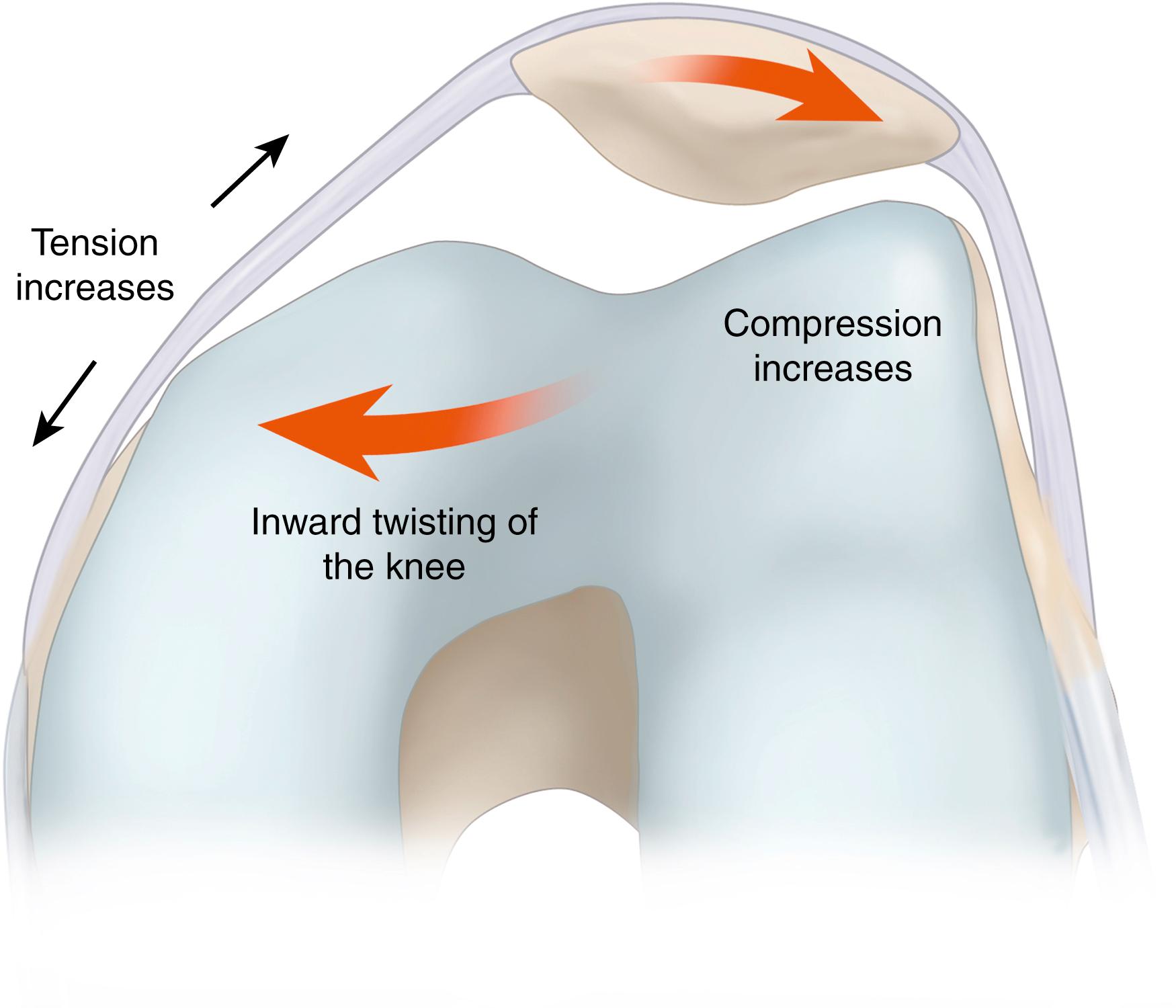 Fig. 29.4, When viewed in the horizontal plane, any increase in the inward twist on the femur increases the medial patellofemoral ligament strain and increases the lateral facet–trochlear compression.