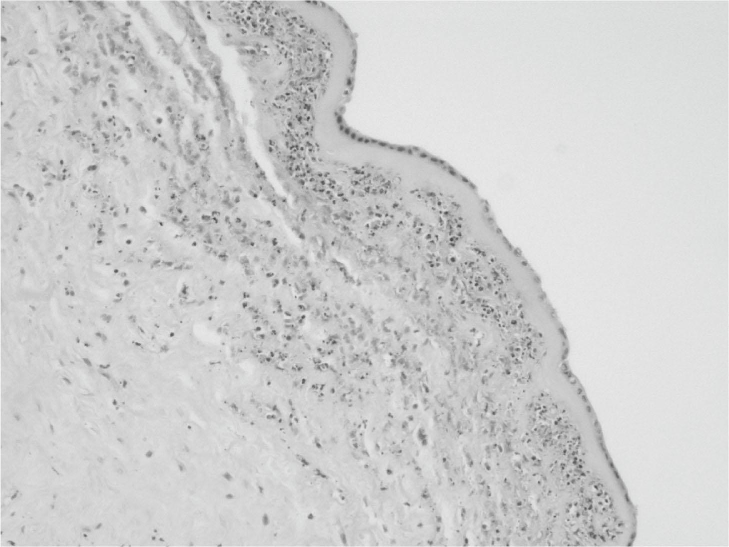 Fig. 6.1, Photomicrograph of fetal membranes from a pregnancy delivered spontaneously at 25 weeks of gestation demonstrating numerous polymorphs infiltrating the fetal membranes (chorioamnionitis); an example of acute inflammation (H&E, ×100).