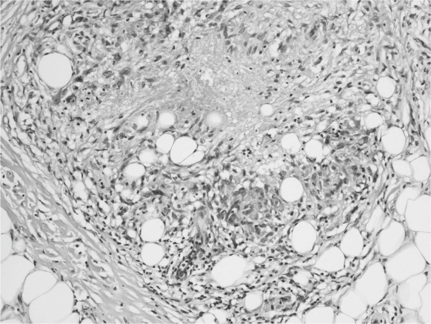 Fig. 6.2, Photomicrograph of a subcutaneous lesion demonstrating granulomatous inflammation with numerous epithelioid macrophages surrounding an area of necrosis, with numerous mononuclear inflammatory cells in the surrounding tissue (H&E, ×250).