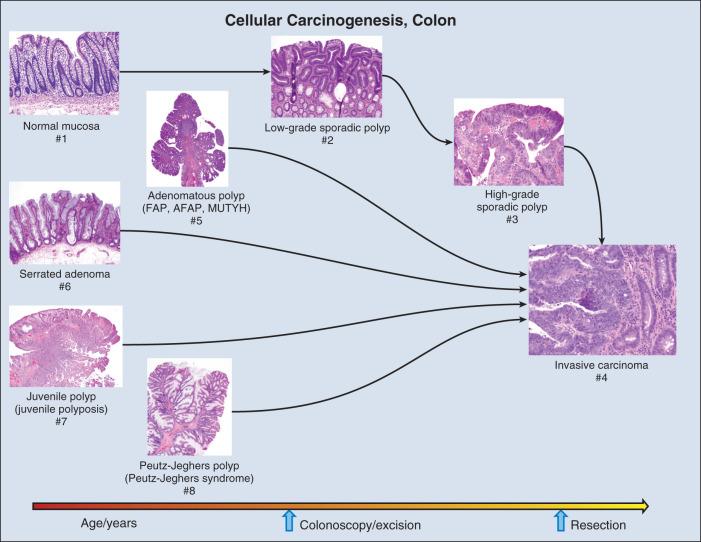 Figure 15.3, This figure depicts progression from 1, normal mucosa through 2, low-grade and 3, high-grade polyps to 4, invasive carcinoma, the last represented by poorly formed clusters of cells pushing aside the normal intestinal crypts visible on the right of the frame. Sporadic polyps shown in the upper row of hematoxylin-eosin (H&E)–stained sections are typically pedunculated and composed of proliferating cells extending to the mucosa surface. As cellular atypia increases, there is an overlapping of cells along the irregular mucosal surface of the high-grade polyp. 5, Polyps of FAP, AFAP, and MUTYH are morphologically similar to sporadic polyps but occur at an earlier age. In 6, Lynch syndrome, polyps are flat and individual crypts are preserved without the convolutions present in sporadic polyps. 7, Juvenile polyps are characterized by the presence of mucous cysts (visible on the left side of the frame) and an edematous and inflamed stroma. The surface of the juvenile polyp may be denuded of epithelium, and there may granulation tissue in the mucosa. Finally, 8, Peutz-Jeghers polyps have a complex lobulated appearance and contain smooth muscle bundles in the stalk. Removal of sporadic polyps has been found to reduce the frequency of progression to invasive carcinoma. The presence of invasive carcinoma may require vigorous intervention (discussed elsewhere in this book).