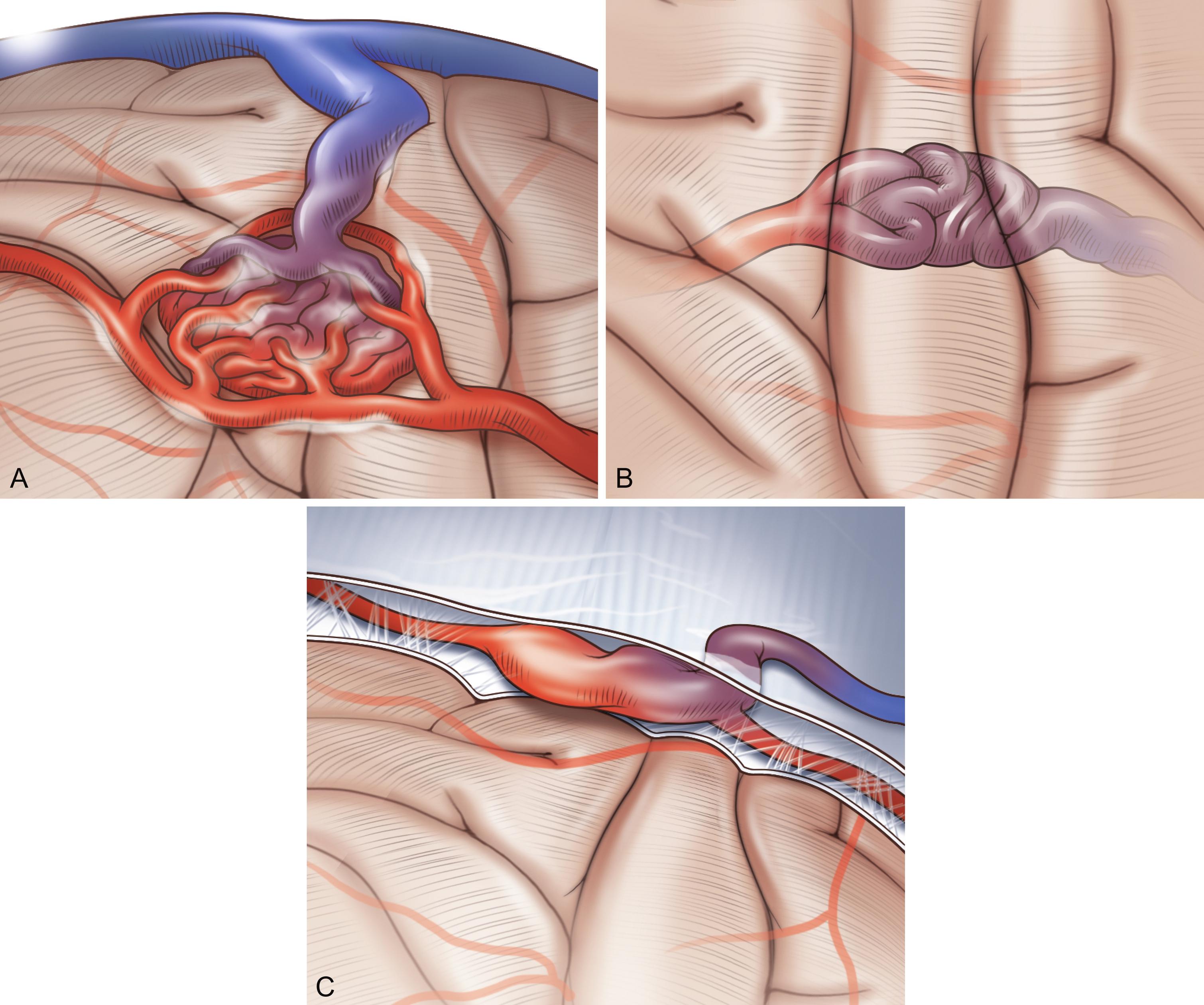 Fig. 2.1, What is an AVM? An AVM is defined by its arterial, intervening nidal, and venous components. In a typical iAVM ( A ) there are multiple arterial connections feeding the nidus; this is referred to as a racemose iAVM. On rare occasions, there is a single feeder so dominant it overwhelms the meaningful appearance of a nidus and looks like a direct connection (or fistula) between an artery and a vein itself ( B ). Those are considered fistular iAVMs if they are located within the substance of the brain (intraaxial: pial or parenchymal location). Similar malformations without an identifiable nidus that are located outside the brain itself (in the bone or meninges) are called arteriovenous fistulae ( C ).