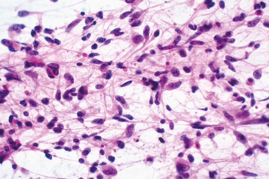 Fig. 72.1, Diffuse Astrocytoma on an Intraoperative Smear.