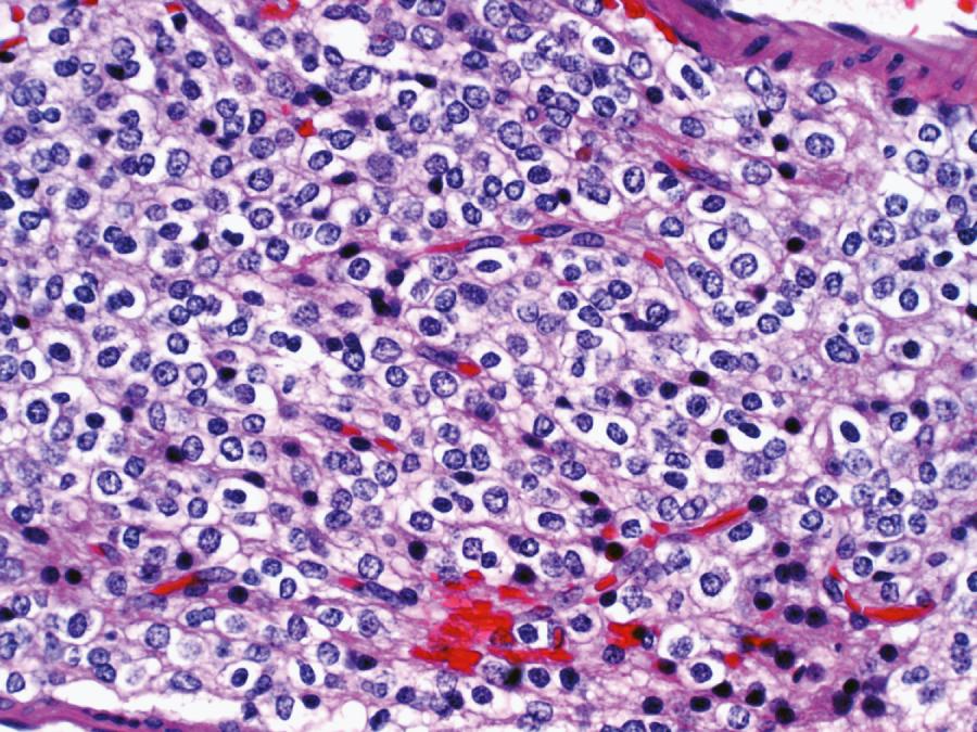 Fig. 72.2, Oligodendroglioma.