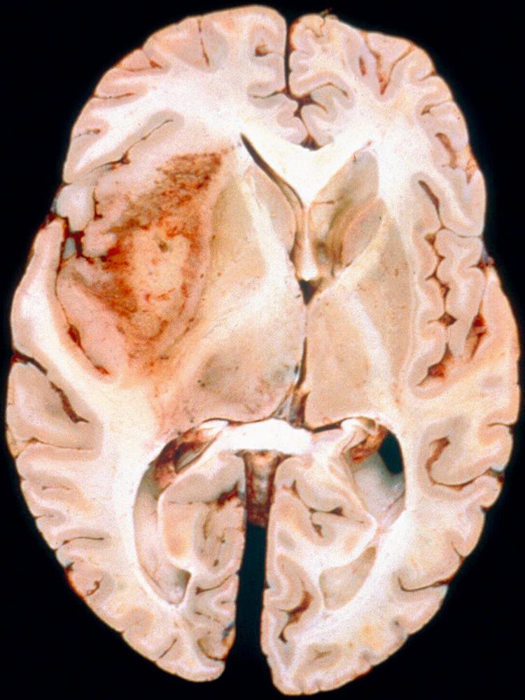 Fig. 72.3, Glioblastoma (Cut in Axial Imaging Plane).