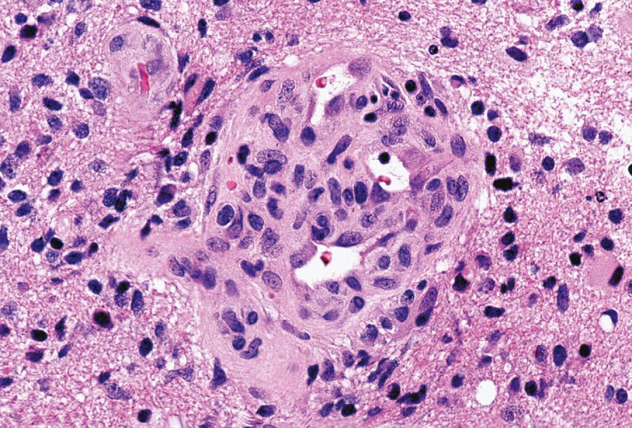 Fig. 72.4, Glioblastoma.